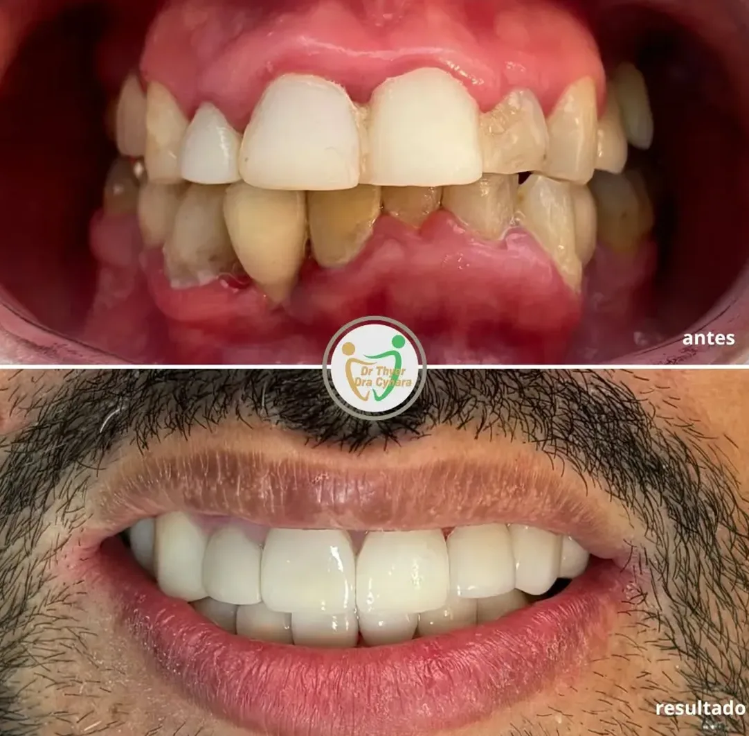 Caso real de tratamento — antes e depois