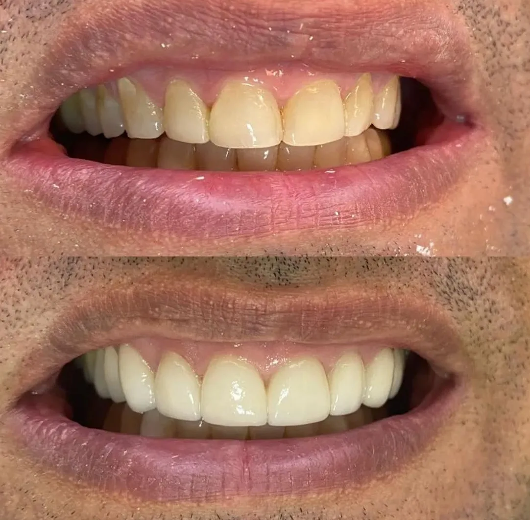 Caso real de tratamento — antes e depois